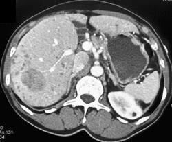 Multifocal Hepatoma - CTisus CT Scan