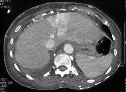 SVC Occlusion With Hot Spot Liver - CTisus CT Scan