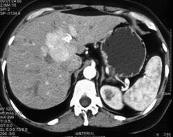 Focal Nodular Hyperplasia (FNH) - CTisus CT Scan