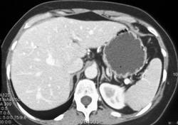 Focal Nodular Hyperplasia (FNH) - CTisus CT Scan