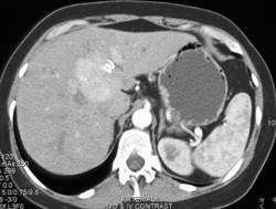 Focal Nodular Hyperplasia (FNH) - CTisus CT Scan