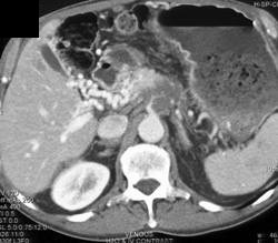 Cavernous Transformation of the Portal Vein - CTisus CT Scan