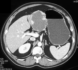 Giant Hemangioma - CTisus CT Scan