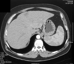 Subtle Metastases From Colon Cancer - CTisus CT Scan