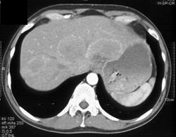 Metastases From Carcinoid - CTisus CT Scan