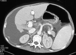 Cirrhosis - CTisus CT Scan