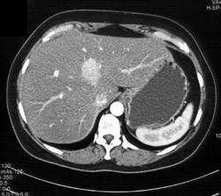 Focal Nodular Hyperplasia (FNH) - CTisus CT Scan