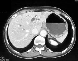 Metastatic Pancreatic Cancer - CTisus CT Scan