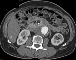 Hemangioma and Dot Sign - CTisus CT Scan