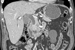 Dilated Common Bile Duct Due to 1 Cm Mass - CTisus CT Scan