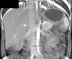 Normal Arterial Phase Liver - CTisus CT Scan