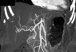 Normal Hepatic Artery - CTisus CT Scan