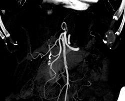 Normal Hepatic Artery and 1 Cm Hemangioma - CTisus CT Scan