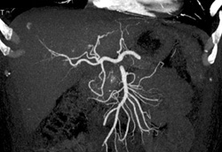 Normal Arterial Anatomy - CTisus CT Scan