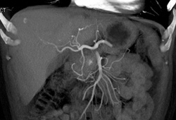 Normal Celiac Bifurcation - CTisus CT Scan