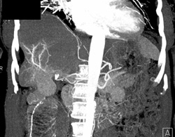 Cirrhosis With Prominent Hepatic Arteries - CTisus CT Scan