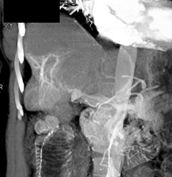 Fibrosis and Retraction Liver - CTisus CT Scan