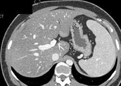 Fatty Liver - CTisus CT Scan