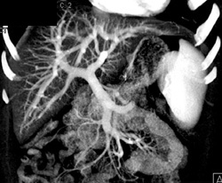 Fatty Liver - CTisus CT Scan