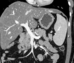 Normal Vascular Mapping - CTisus CT Scan