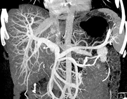 VRT/MIP of Portal Vein - CTisus CT Scan