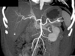 MIP/VRT of Hepatic Vessels - CTisus CT Scan