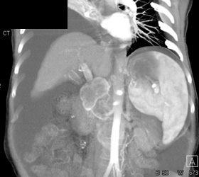 Hepatoma With Nodes - CTisus CT Scan