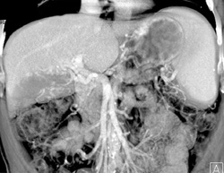 Injury to Right Lobe of Liver - CTisus CT Scan