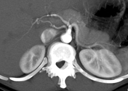 Right Hepatic Artery Off Aorta - CTisus CT Scan