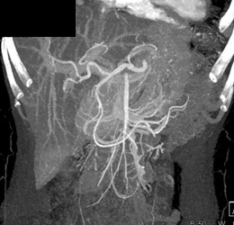 Normal Hepatic Artery - CTisus CT Scan