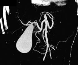 Normal Gallbladder - CTisus CT Scan