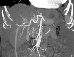 Cirrhosis - CTisus CT Scan