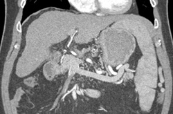 Cirrhosis - CTisus CT Scan