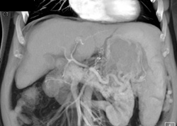 Cirrhosis - CTisus CT Scan