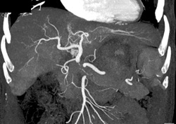 Cirrhosis - CTisus CT Scan