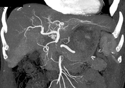 Cirrhosis - CTisus CT Scan