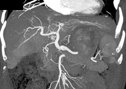 Cirrhosis - CTisus CT Scan