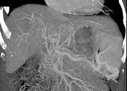 Cavernous Transformation of the Portal Vein - CTisus CT Scan