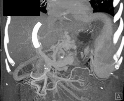 Transjugular Intrahepatic Portosystemic Shunt (TIPS) With Varices - CTisus CT Scan