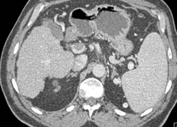 Portal Vein Thrombosis - CTisus CT Scan