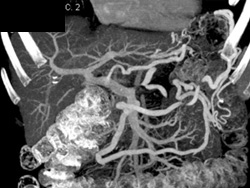 Occluded Splenic Vein With Collaterals - CTisus CT Scan