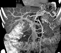 Splenic Vein Occlusion - CTisus CT Scan