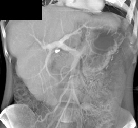 Cirrhosis With Splenic Vein Occlusion - CTisus CT Scan