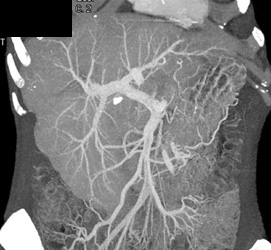 Splenic Vein Occlusion With Cirrhosis - CTisus CT Scan