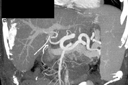 Prior Liver Infarct S/P Transplant - CTisus CT Scan