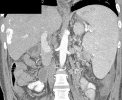 S/P Liver Transplant With Infarct - CTisus CT Scan