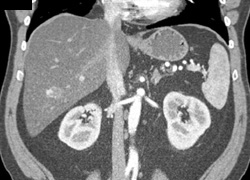 Hemangioma in A Fatty Liver - CTisus CT Scan