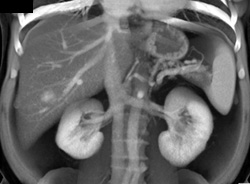 Fatty Liver - CTisus CT Scan