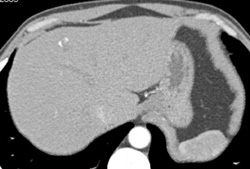 Hemangioma - CTisus CT Scan