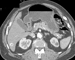 Hemangioma - CTisus CT Scan